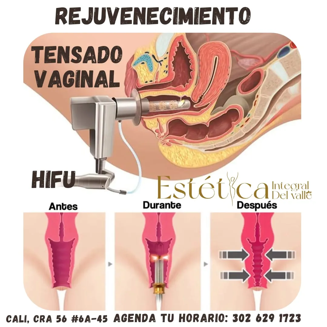 HIFU VAGINAL