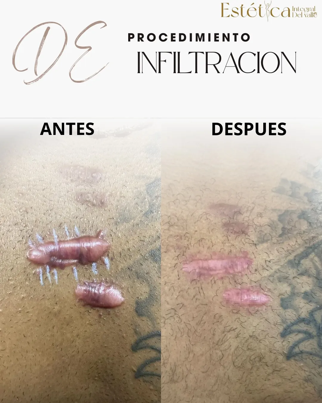 INFILTRACION