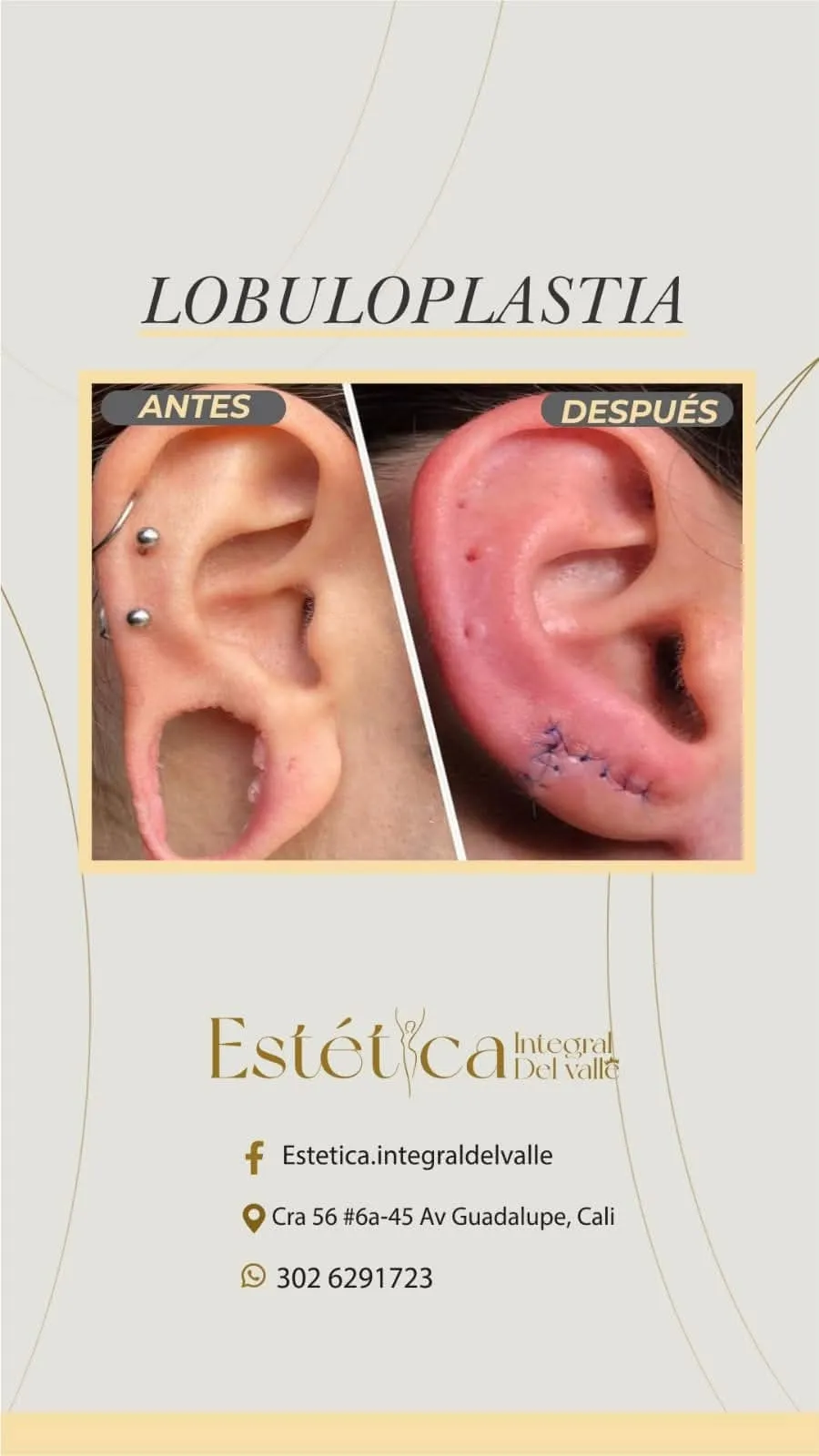 Lobuloplastia 1 orificio rasgado - 1