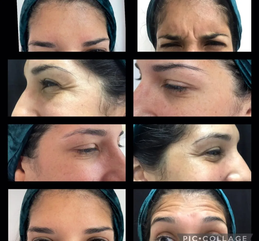 BOTOX 360° 100 UND - 3