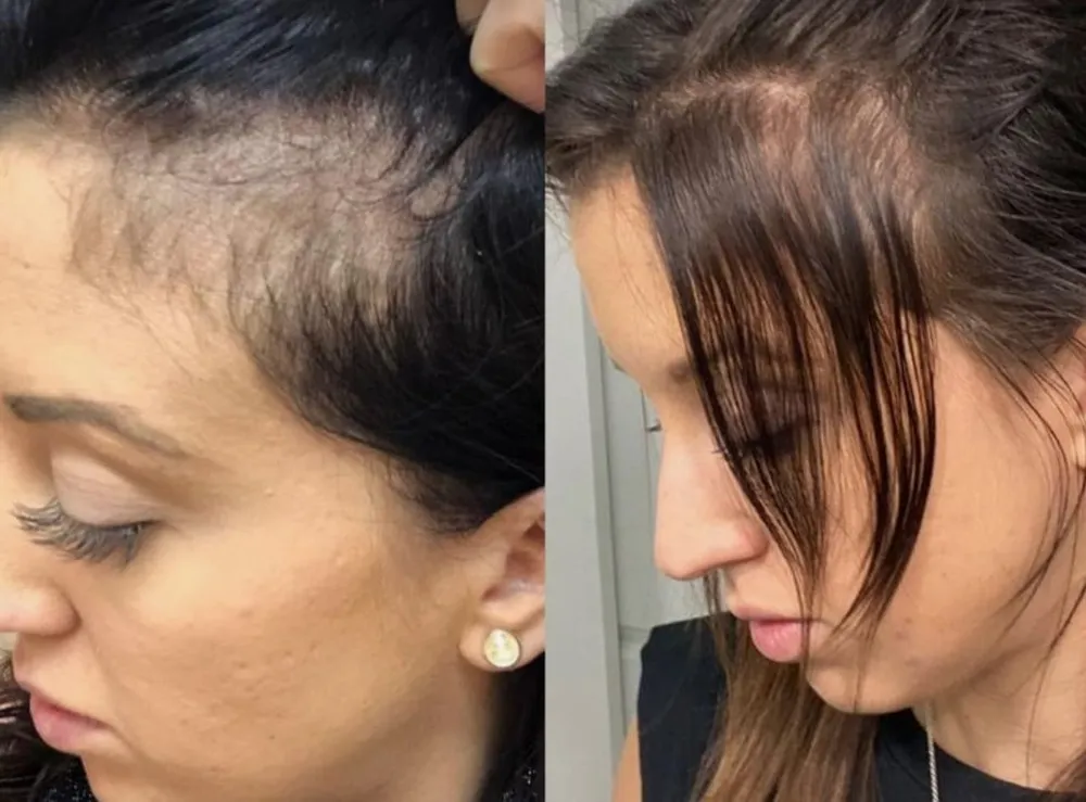 tratamiento caída cabello