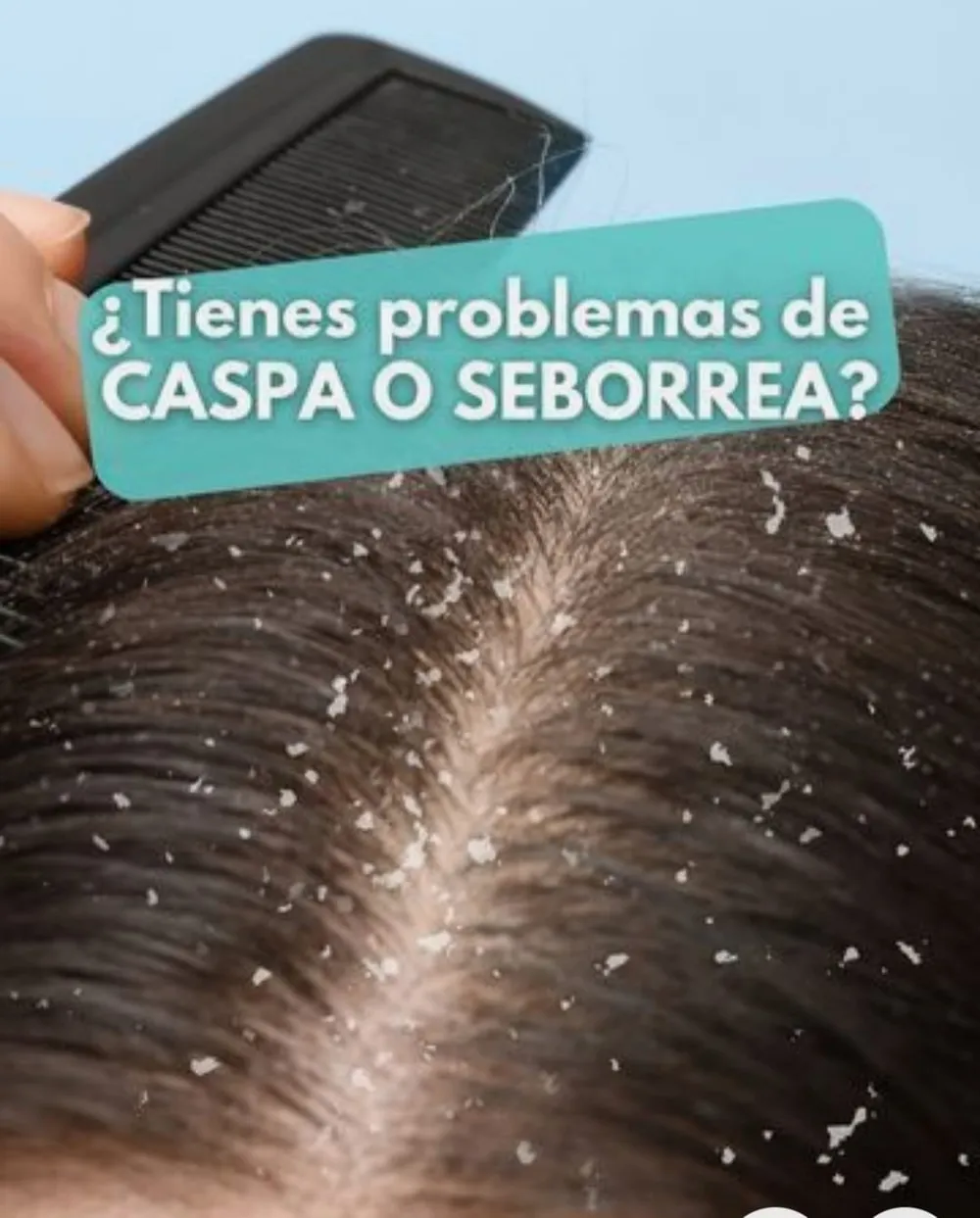 tratamiento caspa