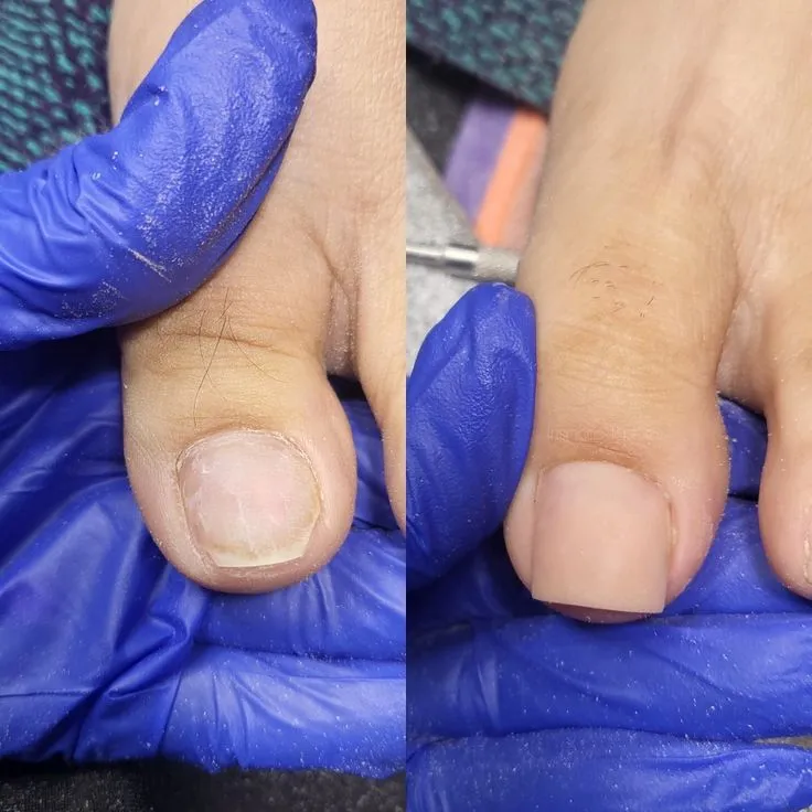 Acripie en Todas Las Uñas - Imagen 1