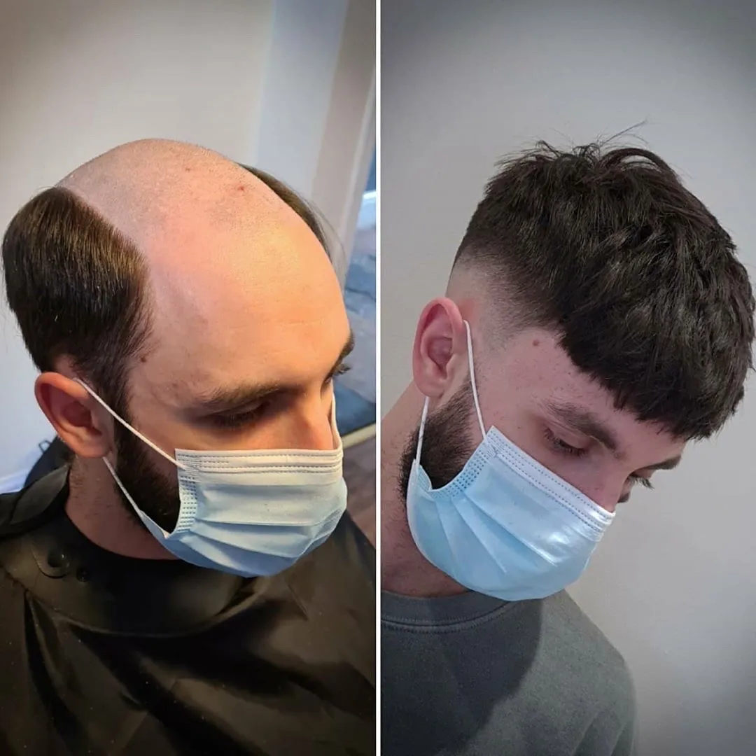 🇪🇺PRÓTESIS CAPILARES🇪🇺 - Imagen 1