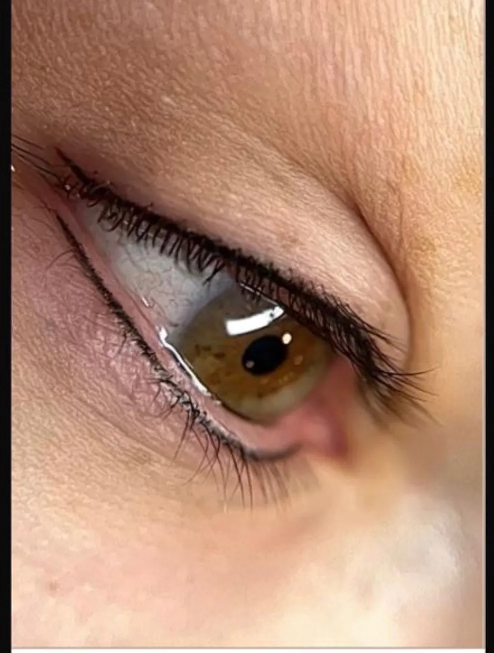 RETOQUE DE PÁRPADO INFERIOR