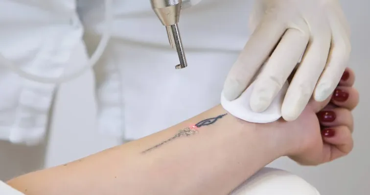 ELIMINACION DE TATUAJES DE HASTA 30CM 