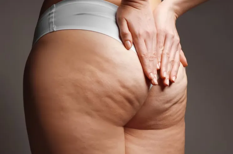 Celulitis Off - Imagen 1