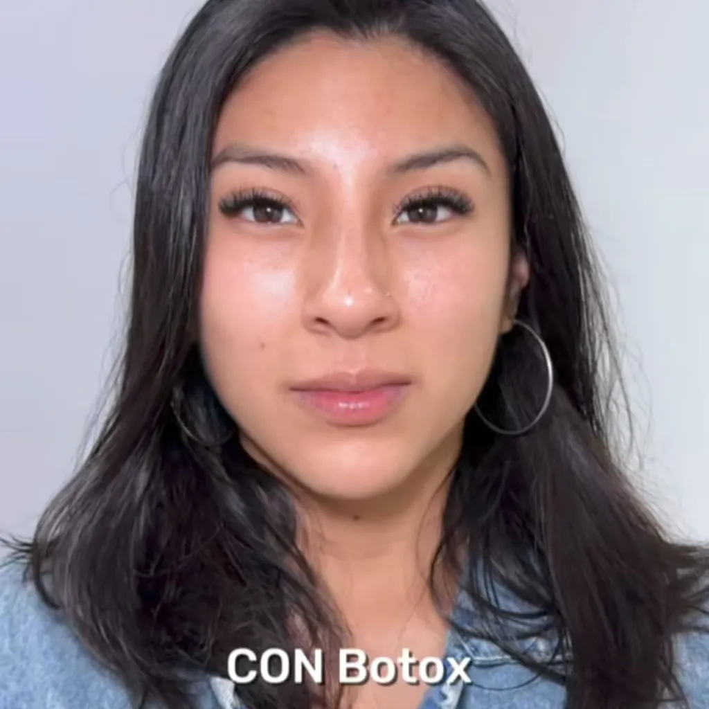 Botox Full Face