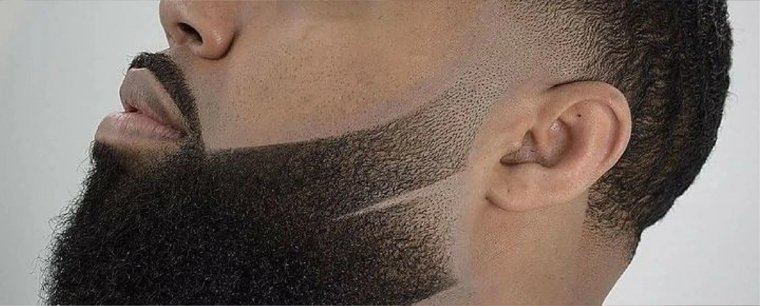 PIGMENTACIÓN DE BARBA // BEARD PIGMENTATION - Imagen 1