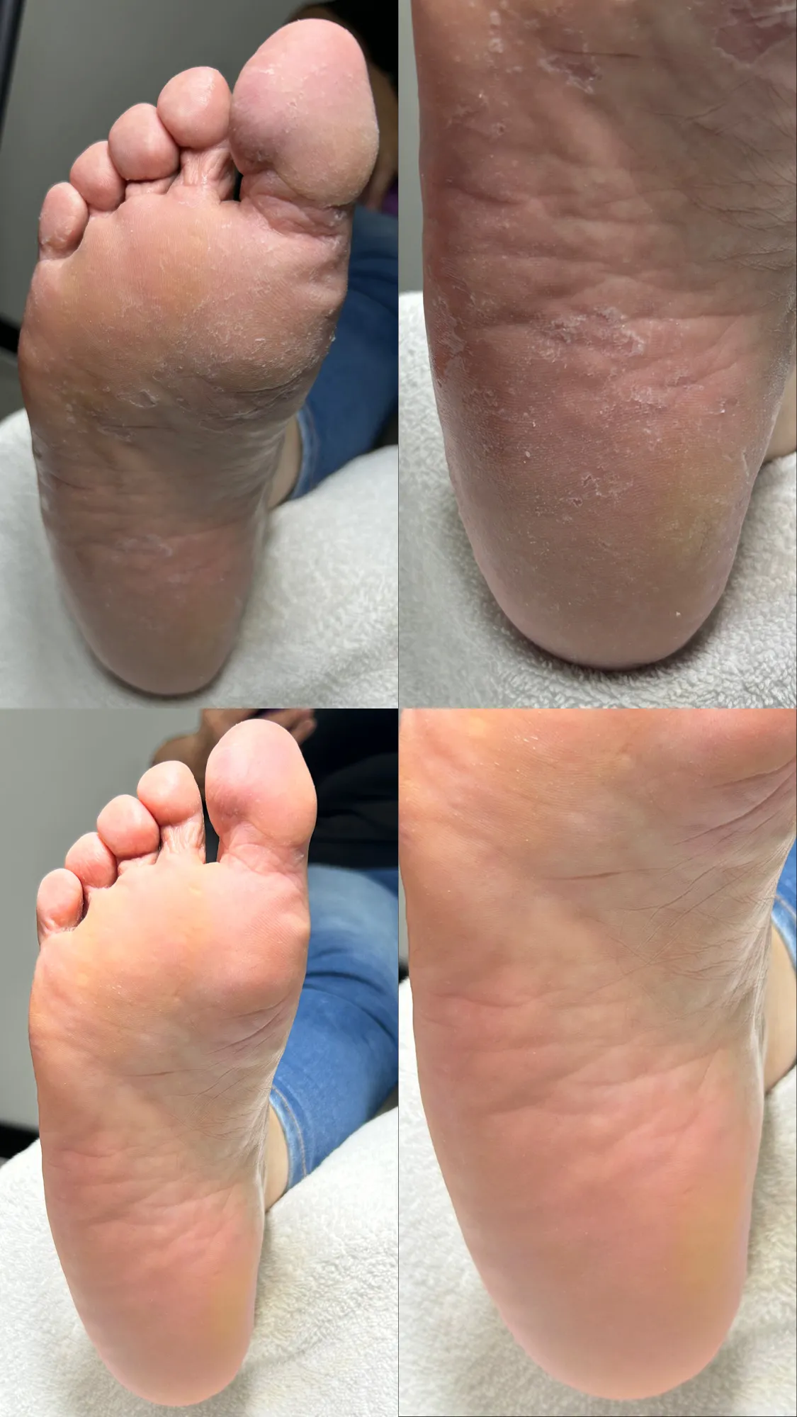 Remoción de hiperqueratosis (callos)