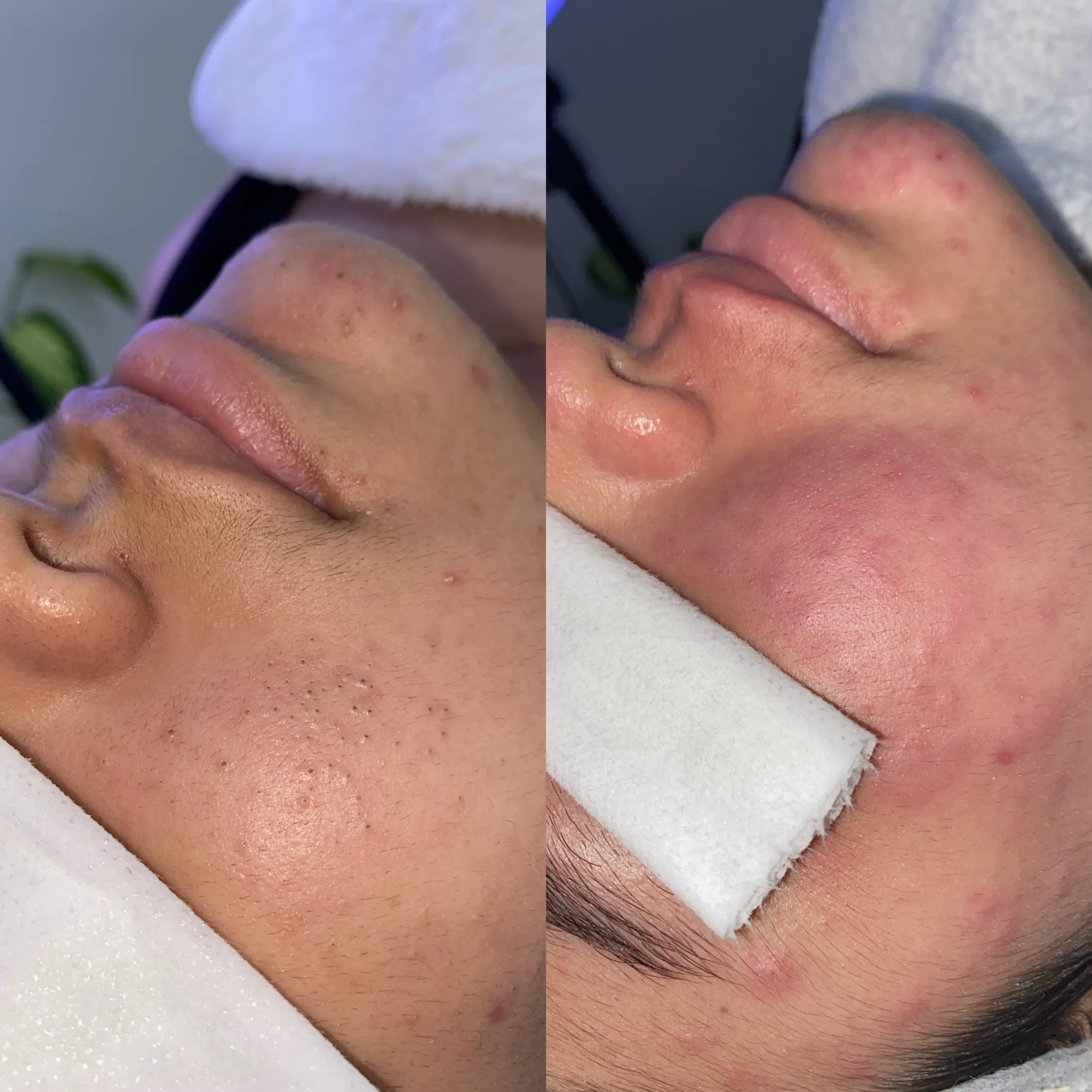 HIGIENE FACIAL PROFUNDA - Imagen 1