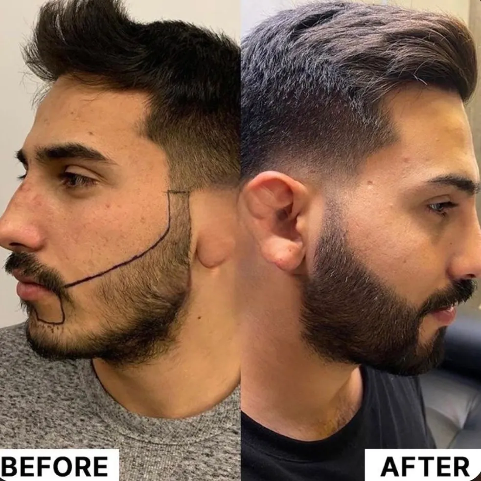 Pigmentación de Barba
