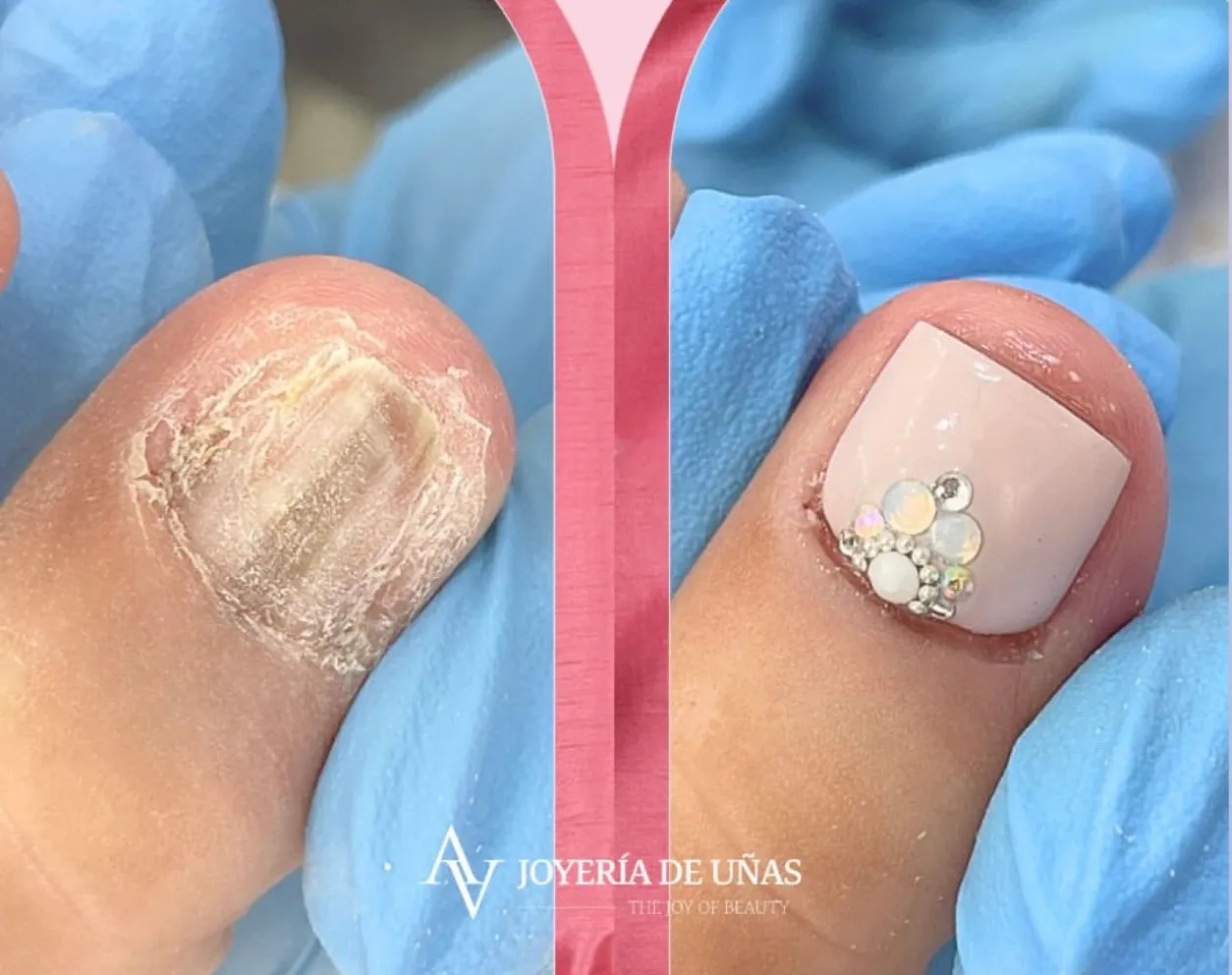 Reconstrucción estética de uñas con Onicomicosis - Imagen 1