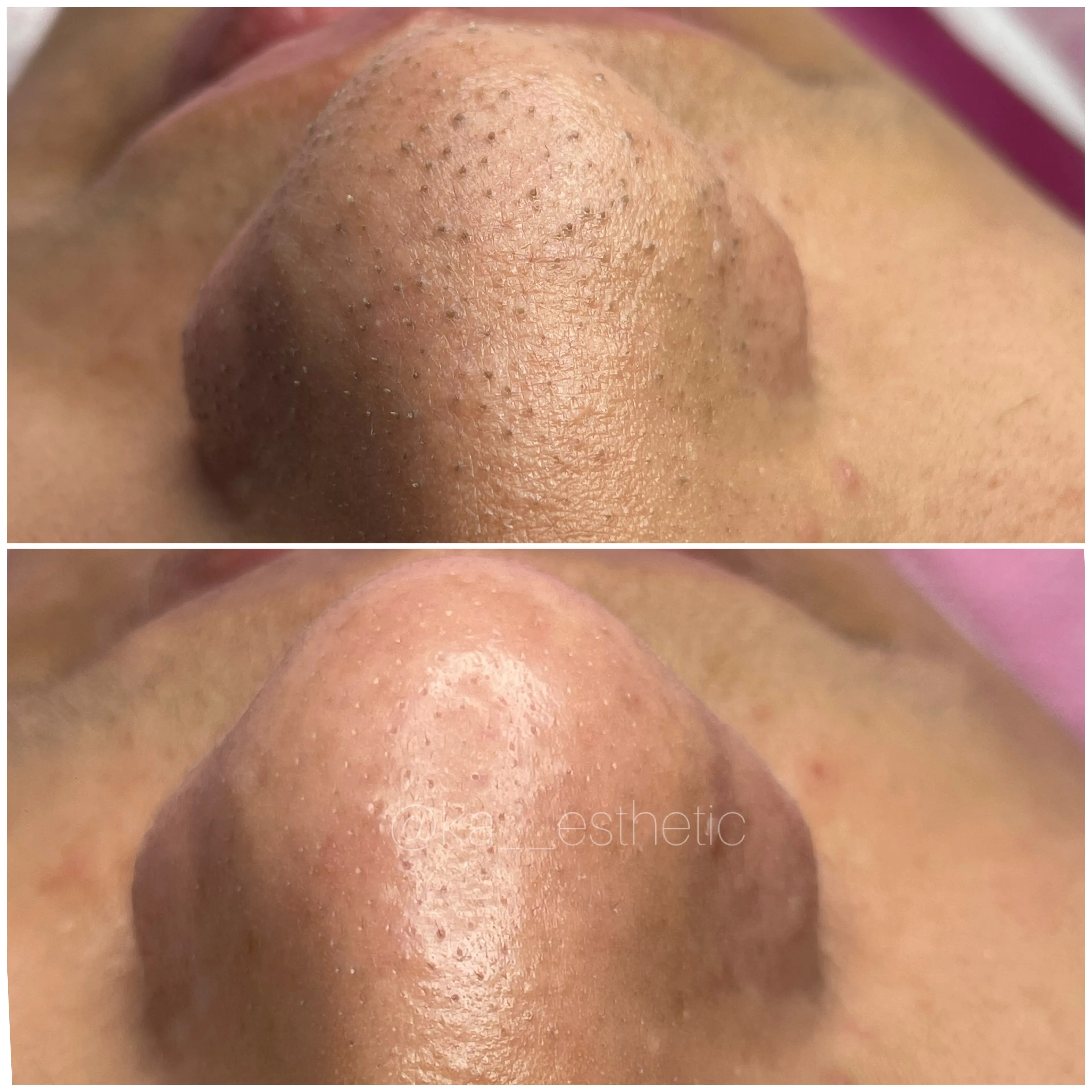 Limpieza facial profunda  - Imagen 1