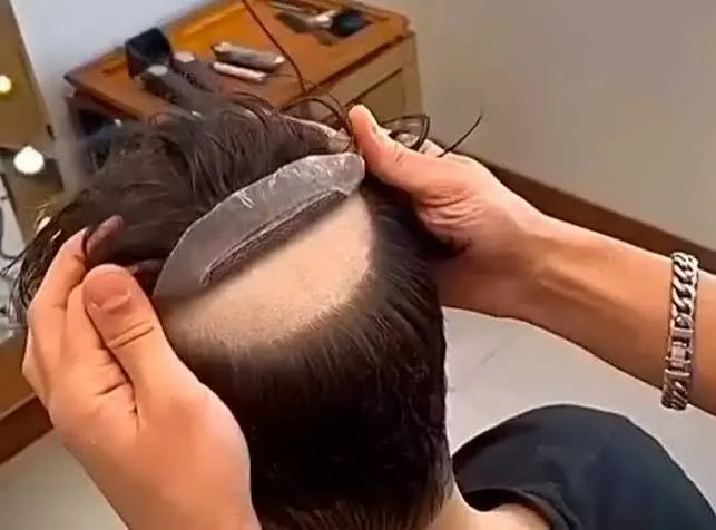 Instalación de prótesis capilar con kit de mantenimiento