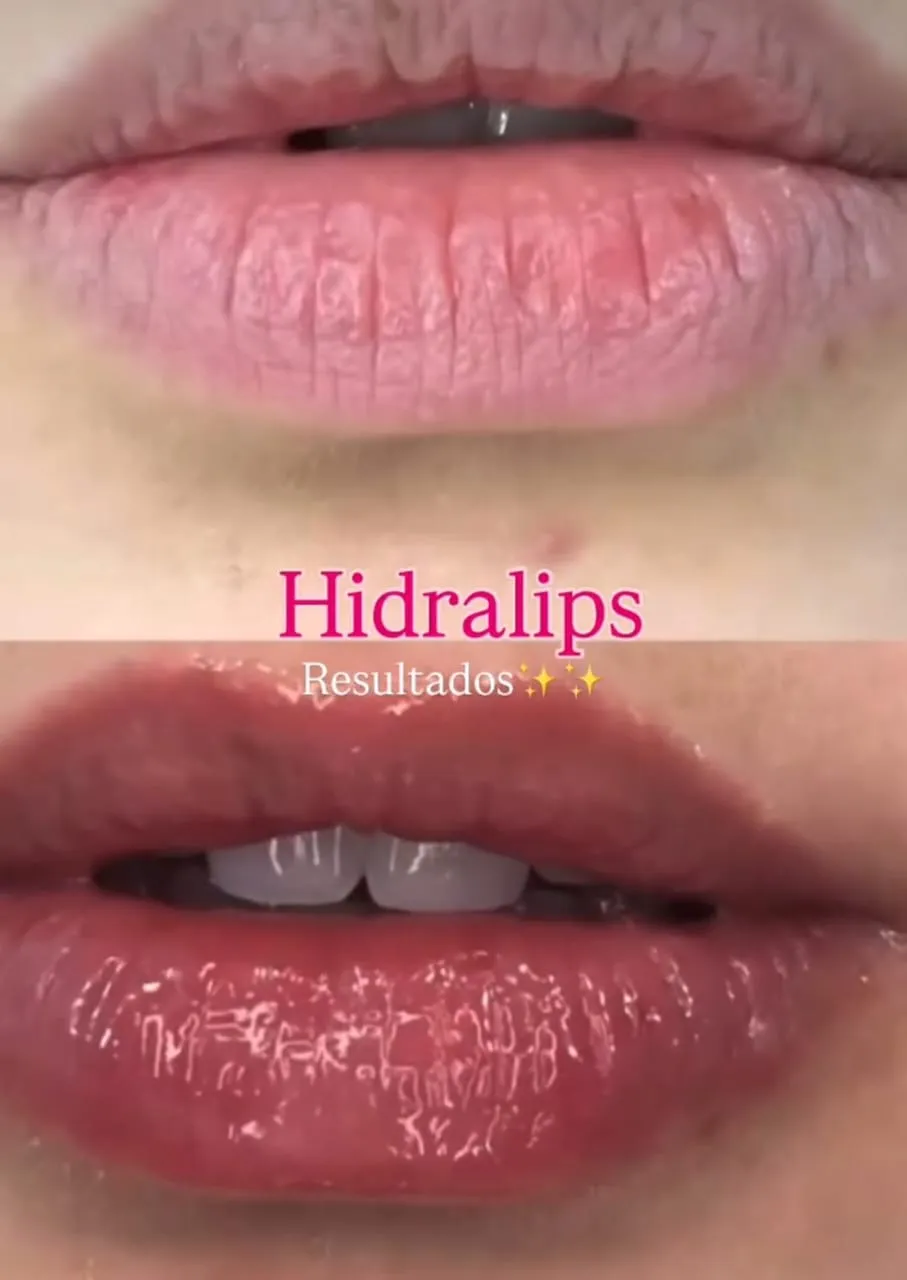 Hidralips - 2