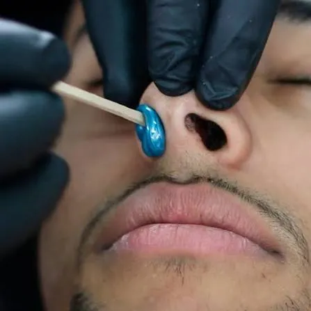 Depilación Nasal
