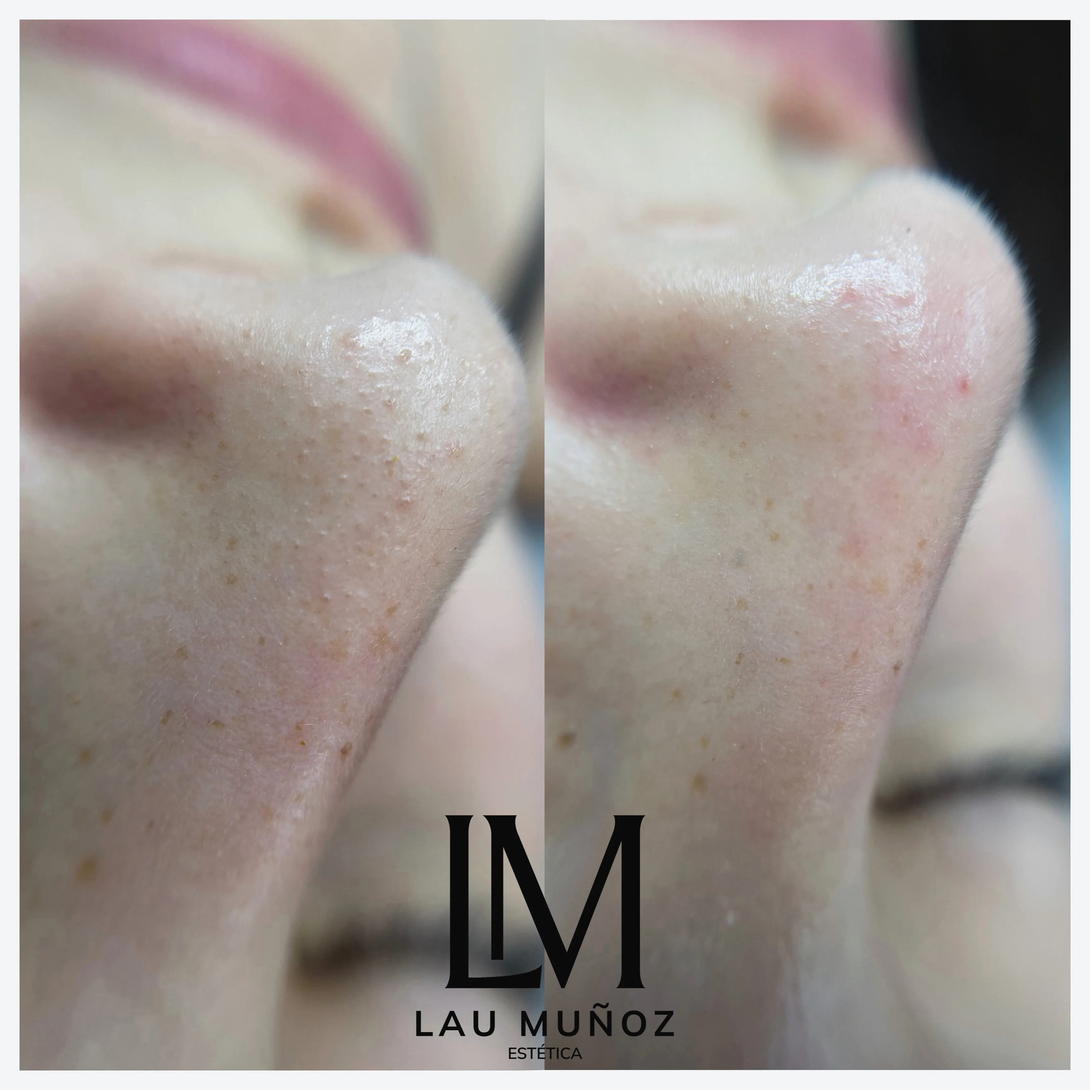Limpieza Facial