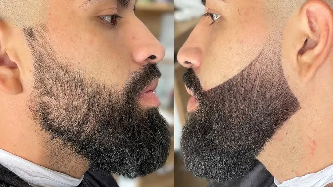 Pigmentacion de barba