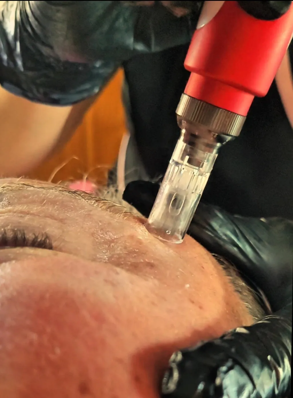 Limpieza facial + dermapen