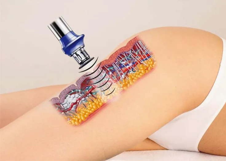 ANTI-CELULITIS - Imagen 1