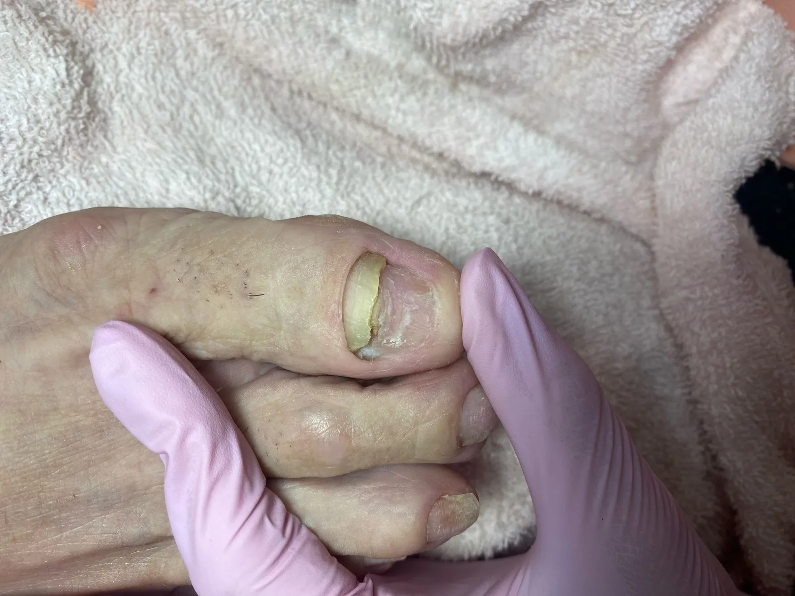 Onicomicosis (Infeccion por hongos en las uñas) 