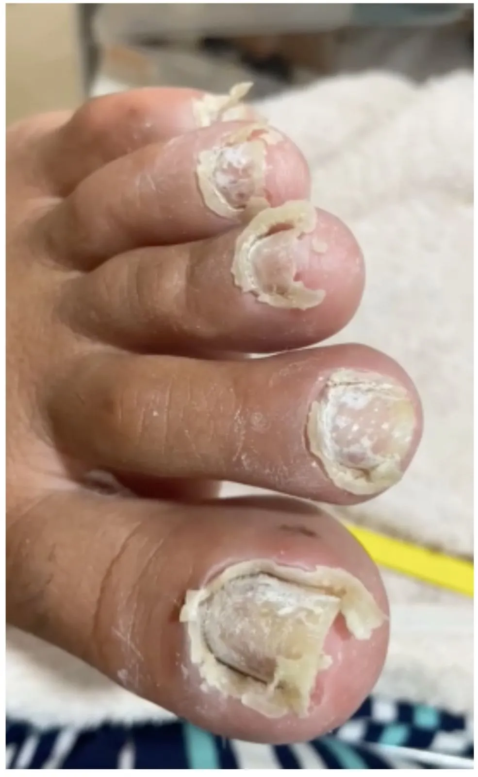 Peeling Químico para Onicofosis 