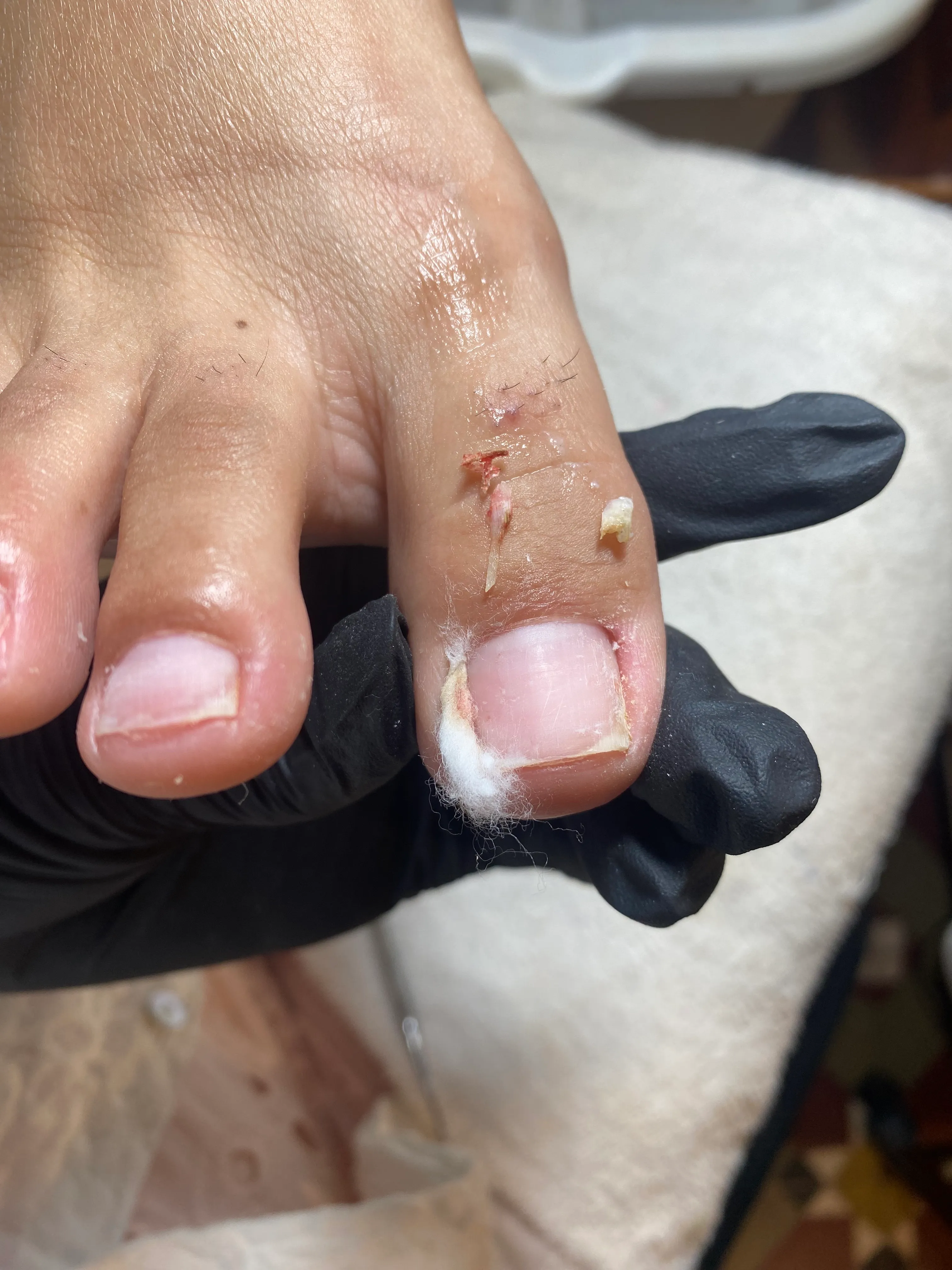 Extracción de uñas Encarnadas con curativo