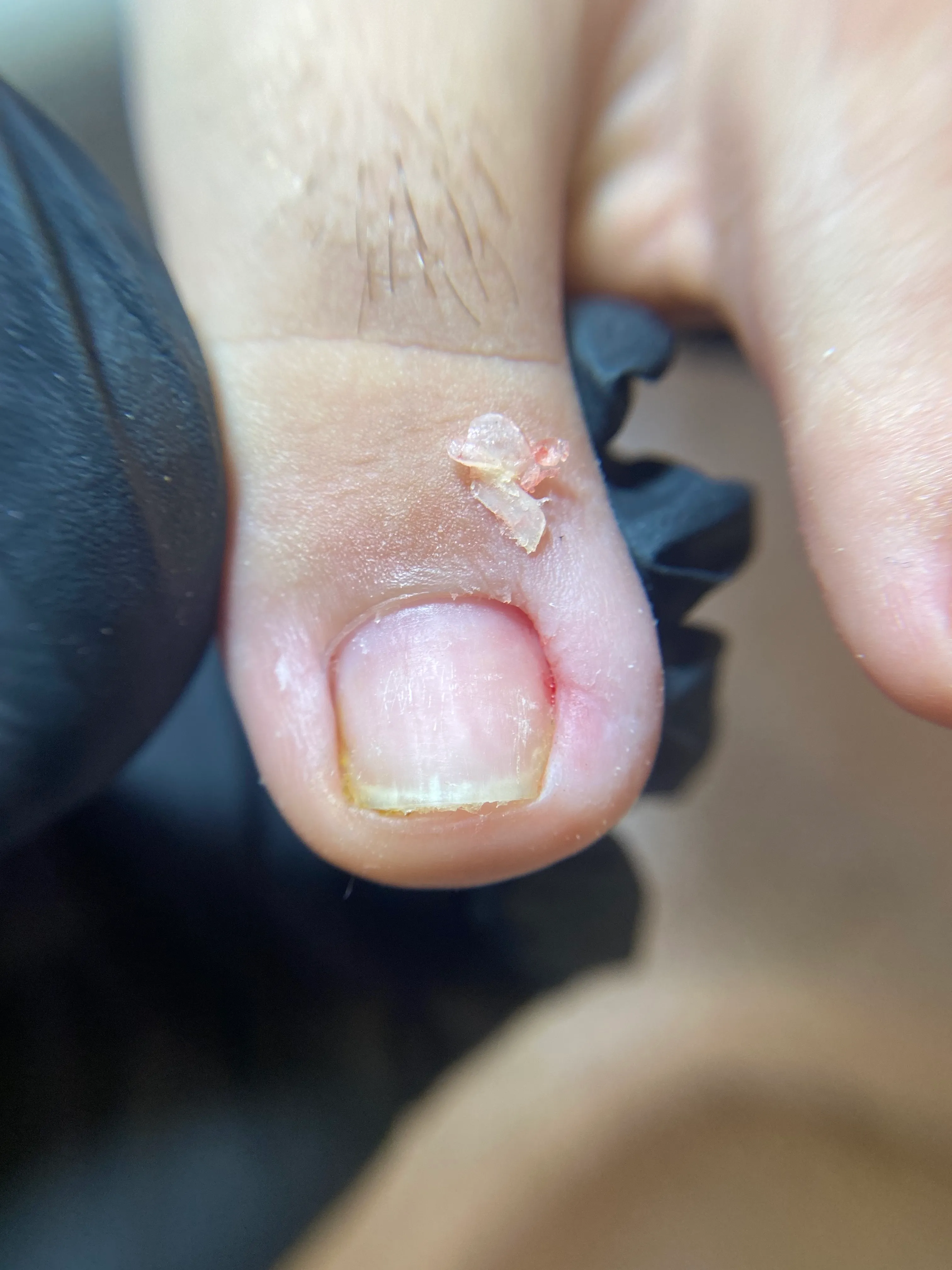 Extracción de uñas encarnadas sin curativo