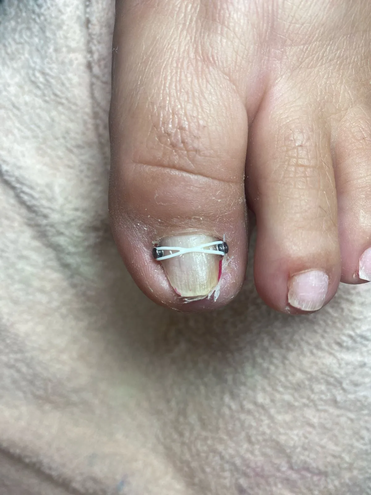 Ortonixia para uñas en recuperación 