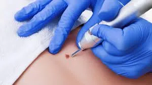 Cauterizacion de Verrugas