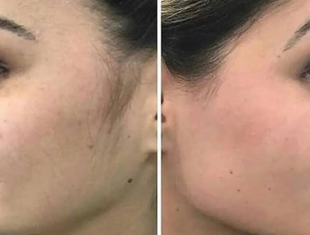 Depilación facial completa con "CERA ESPAÑOLA"