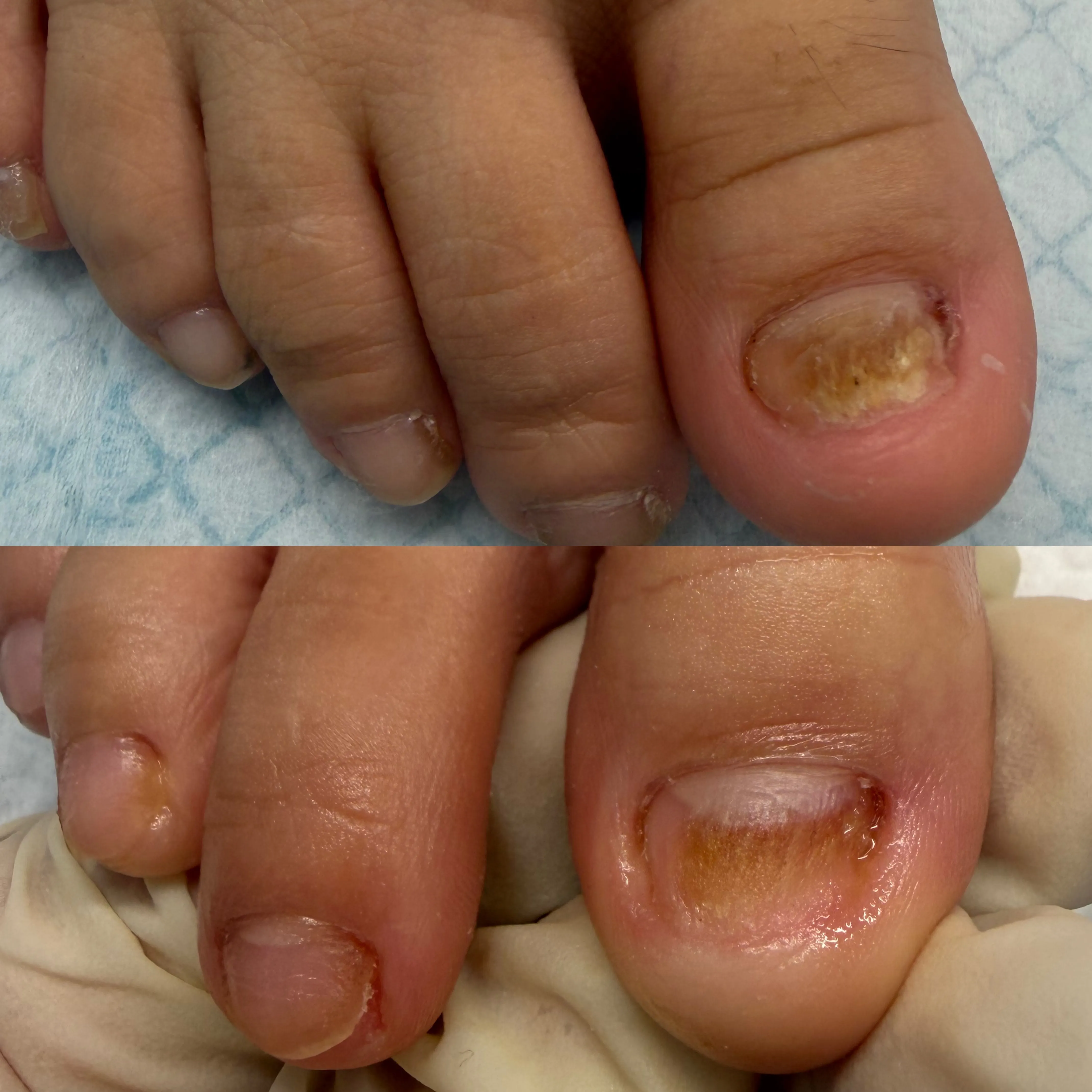 pedicura clinica