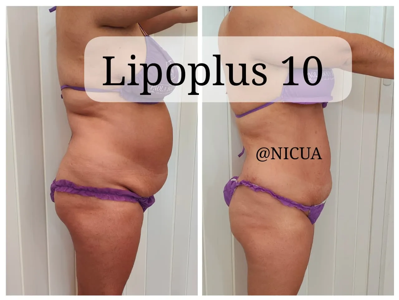 Lipoplus 10