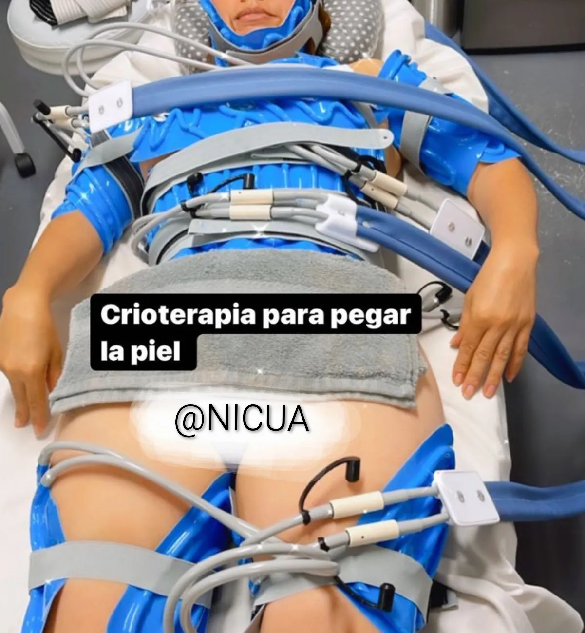Criotherapy