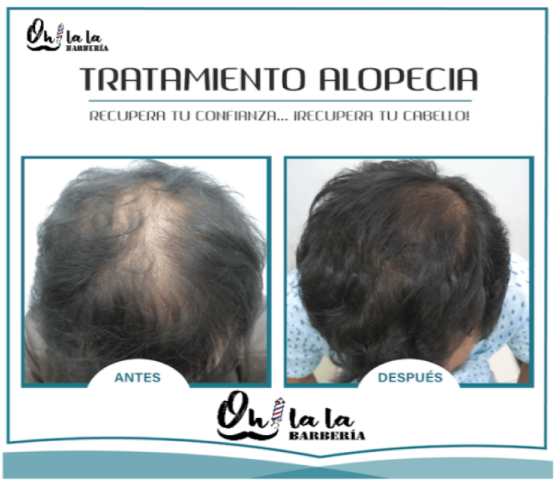 TRATAMIENTO ALOPECIA X 4 SESIONES