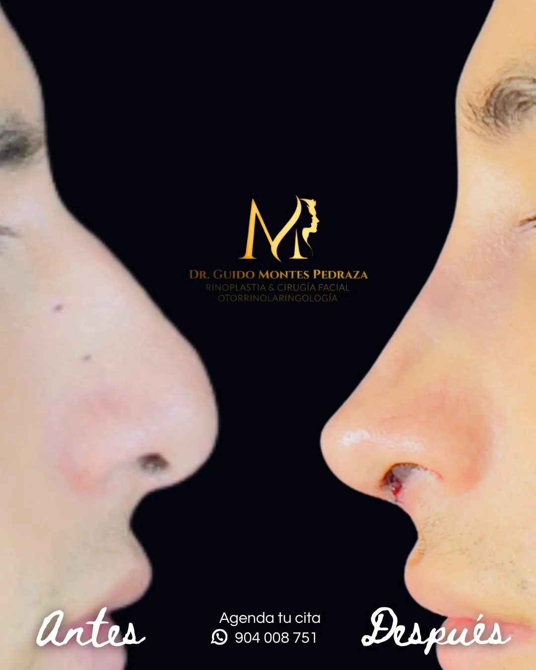 Rinoplastia ultrasonica