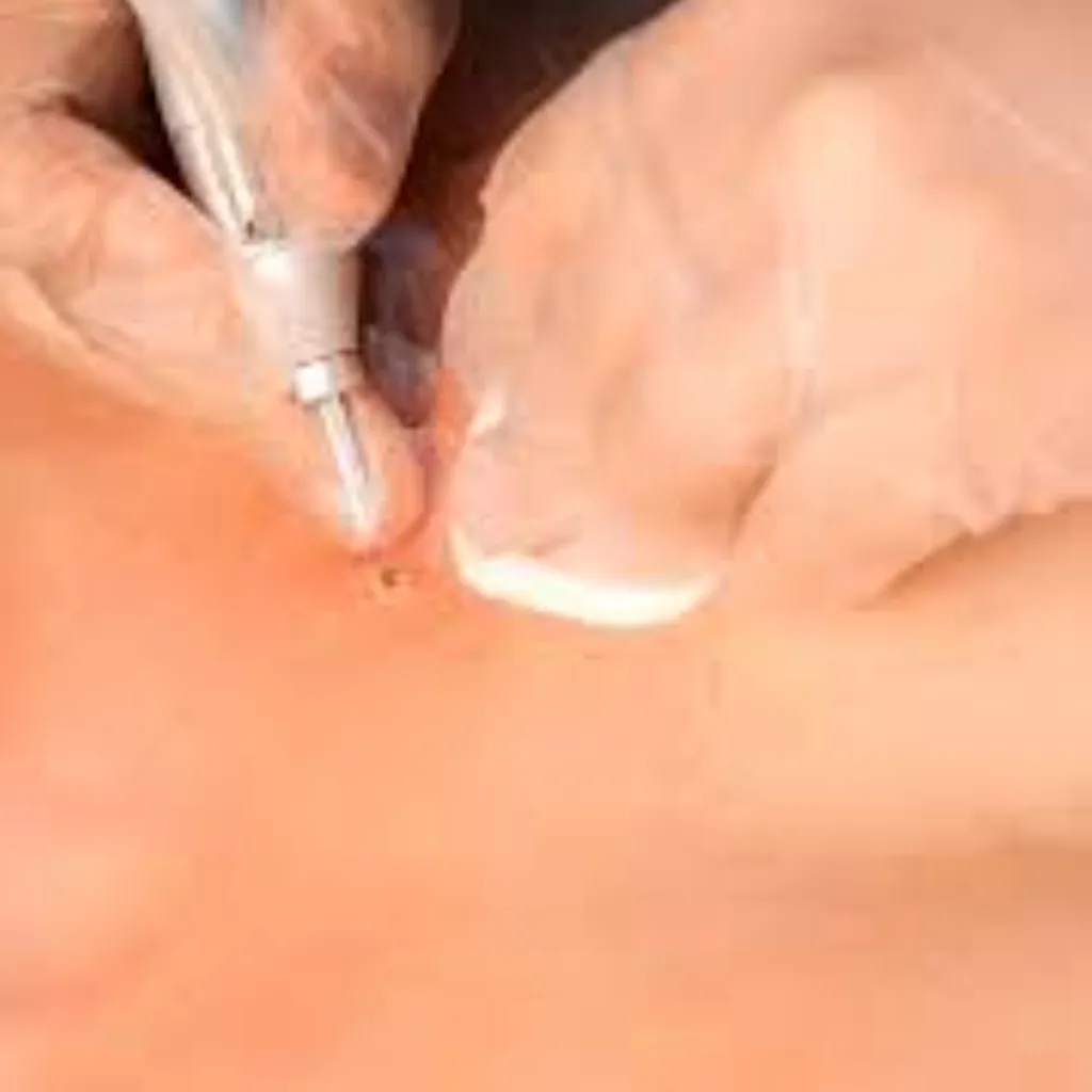 CAUTERIZACION DE VERRUGA ( + 3 VERRUGAS)