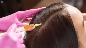 PRP ALOPECIA CAPILAR / SESION