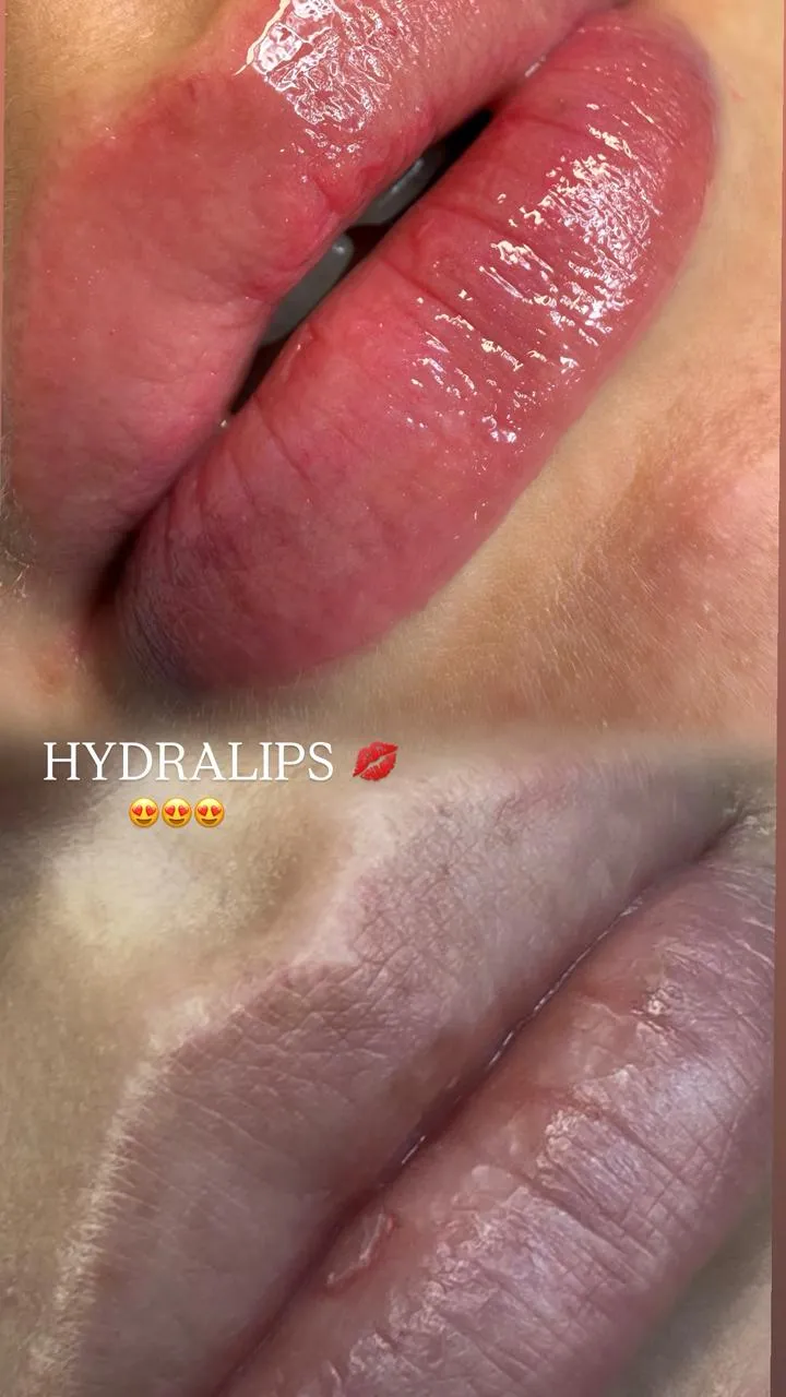 Hydralips - 1