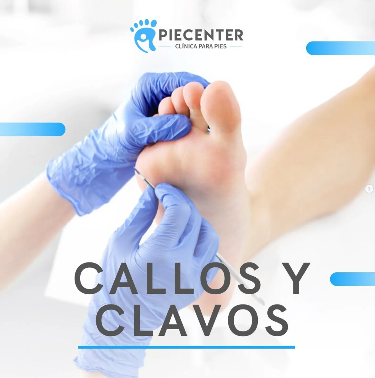 Clavos y Callosidades