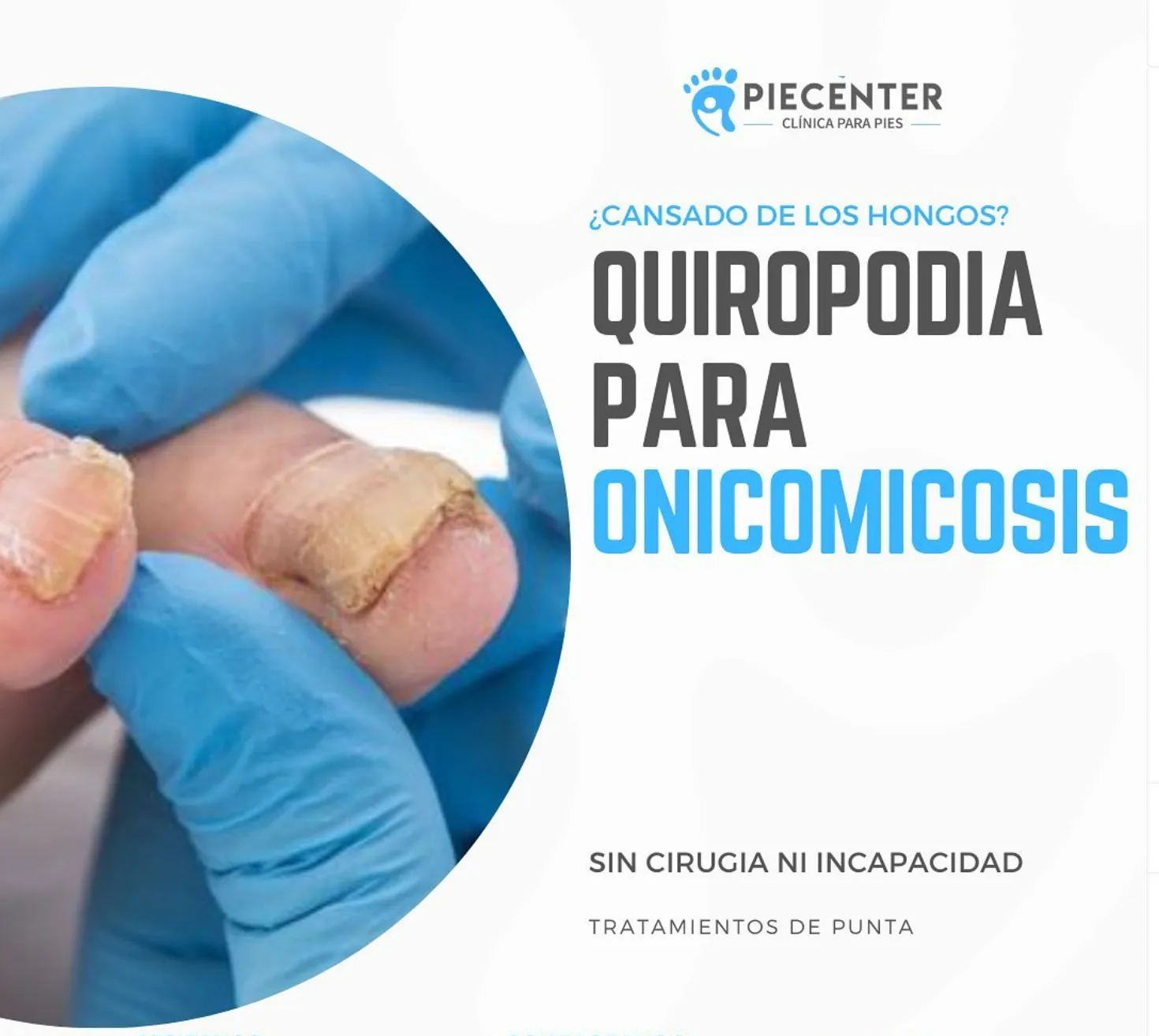 Pedicura para Hongo  - Imagen 1