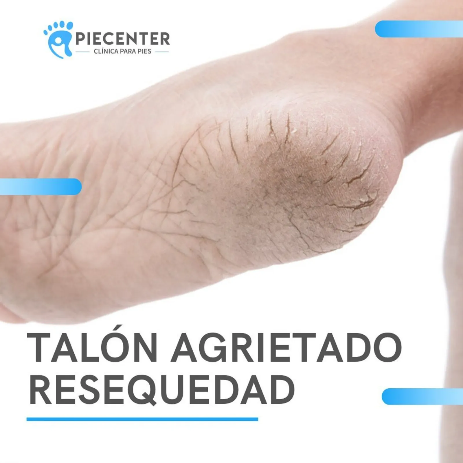 Cuidado de Heridas en los Pies