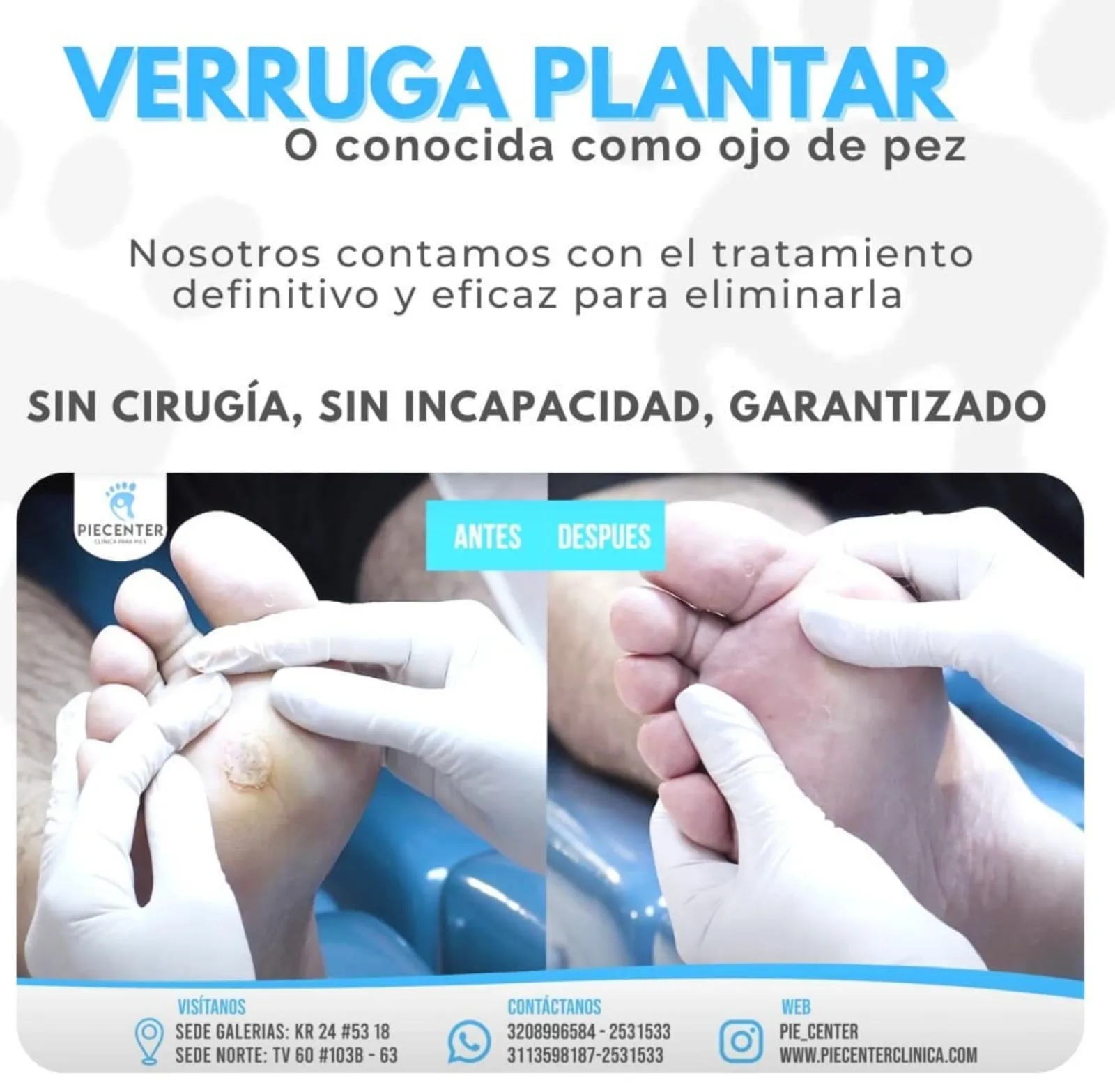 Verrugas Plantares / Ojo de pez