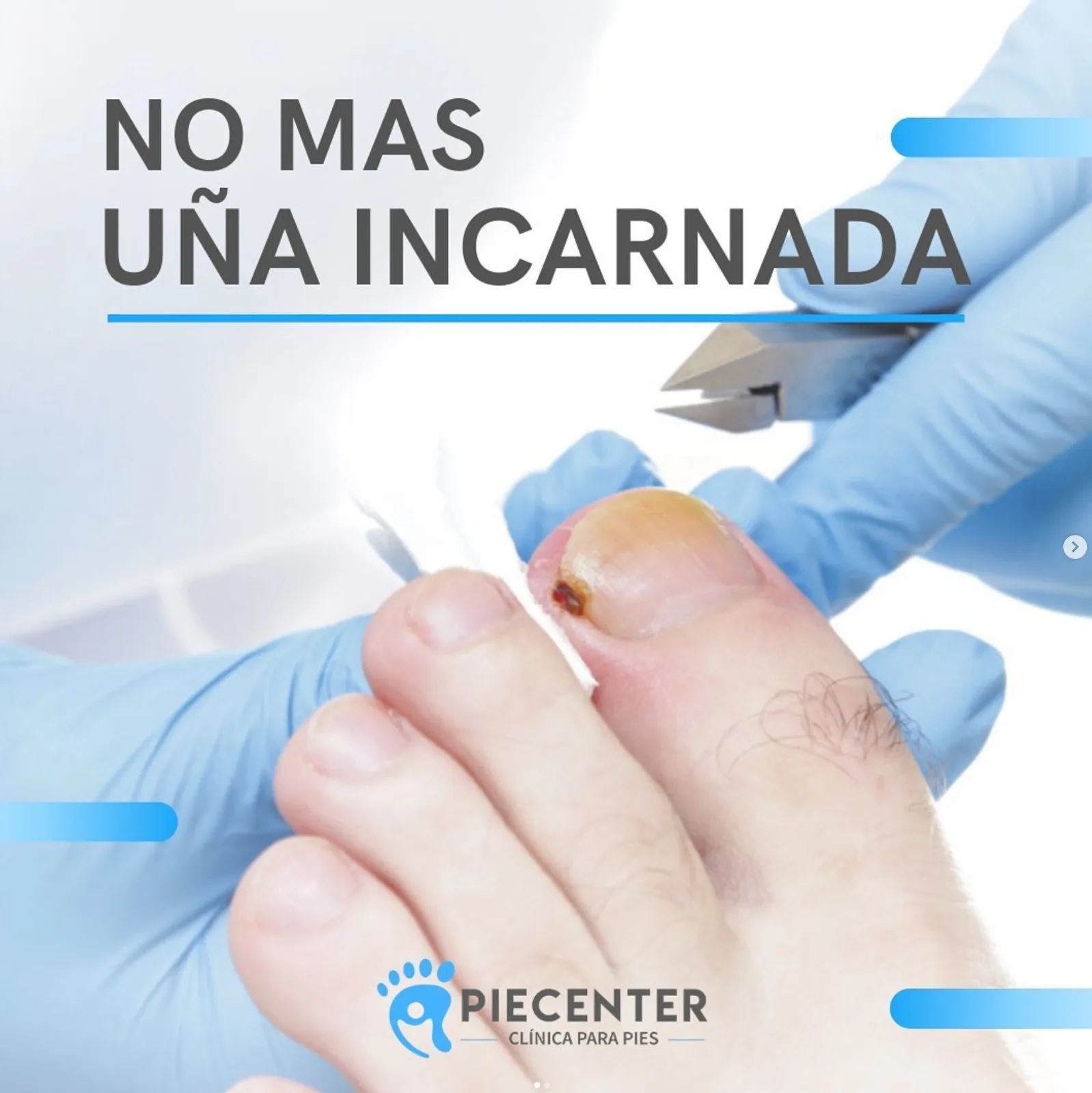 Uña Incrustada / Onicectomía