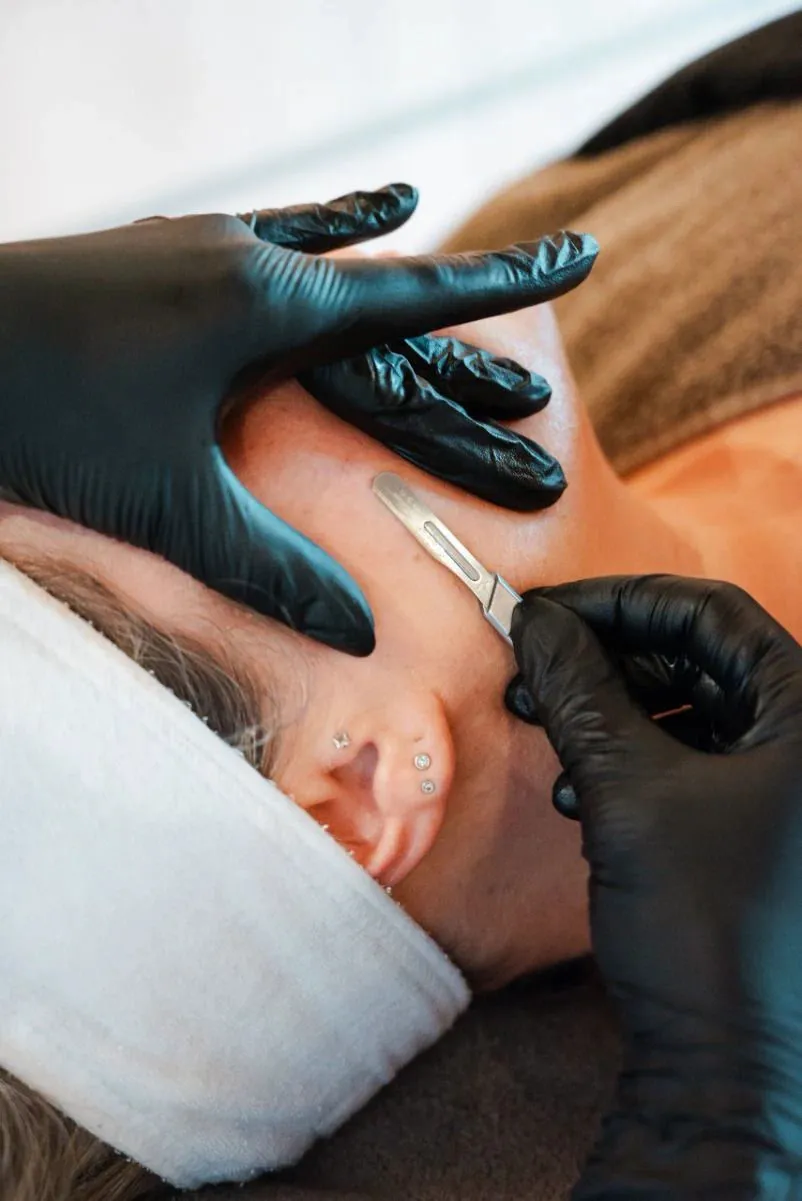 DERMAPLANING