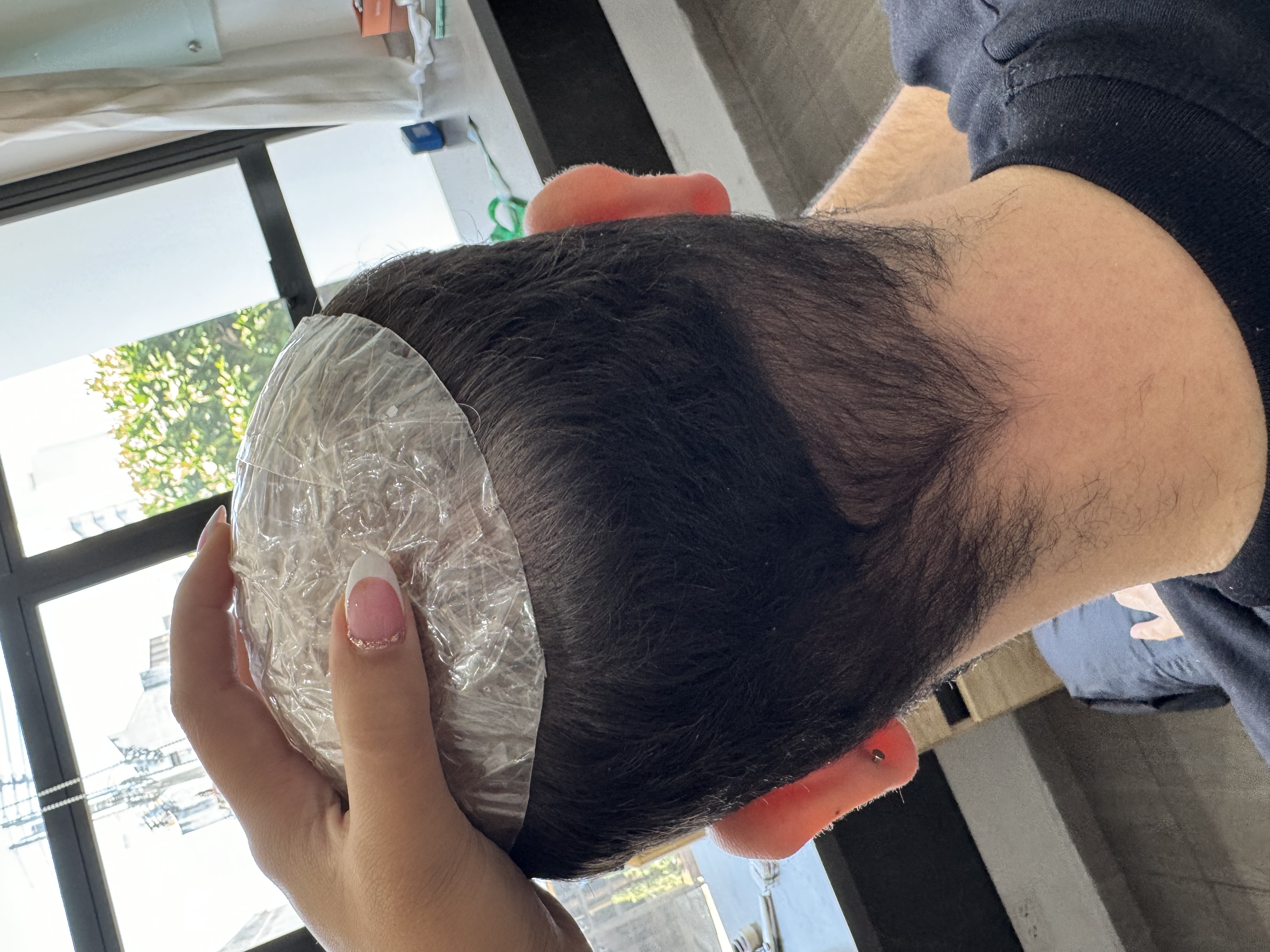 Instalación prótesis capilar  - Imagen 1