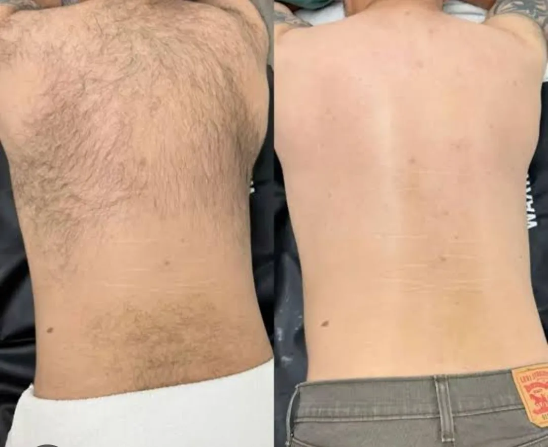 Depilación de Espalda Caballero