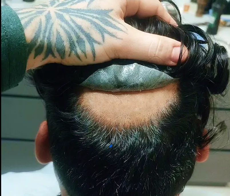 Instalación de protesis capilar