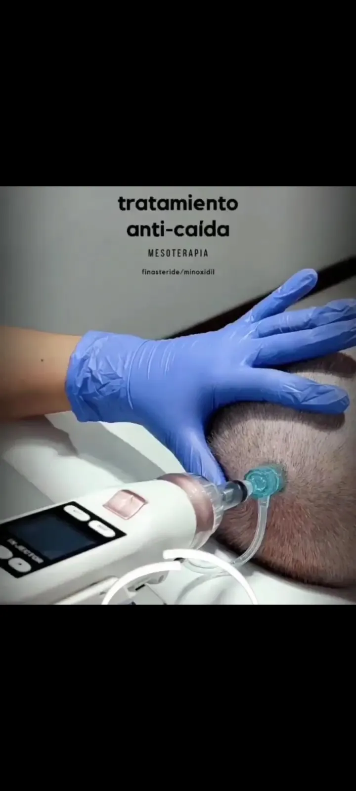 Mesoterapia (sesión) 
